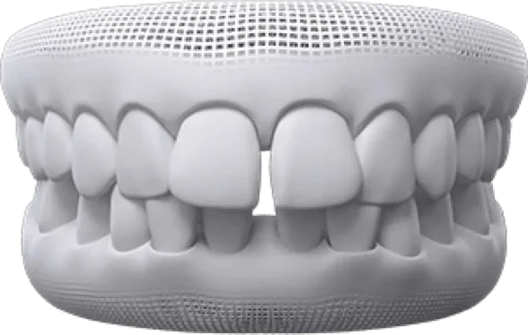 Overbite