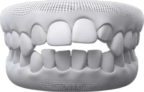 Overbite