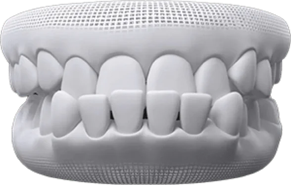 Underbite