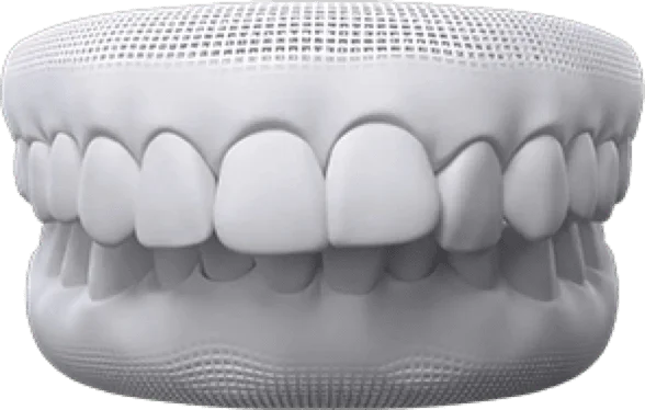 Open bite