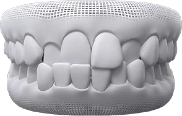 Gaps between teeth