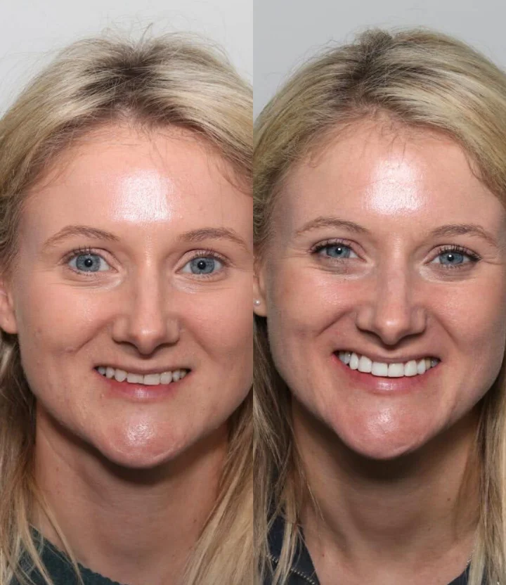 Cosmetic Bonding