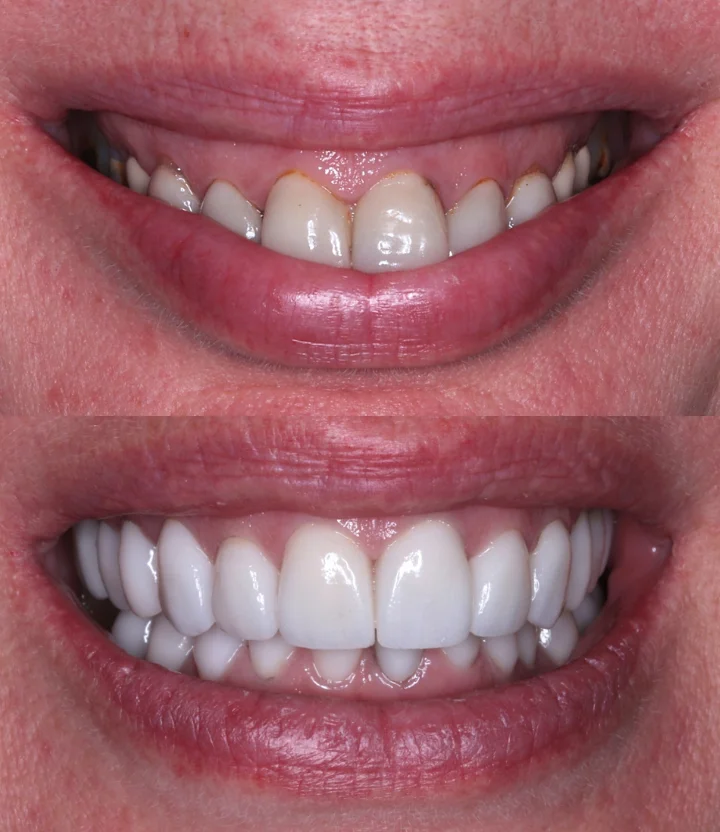 Smile Makeovers