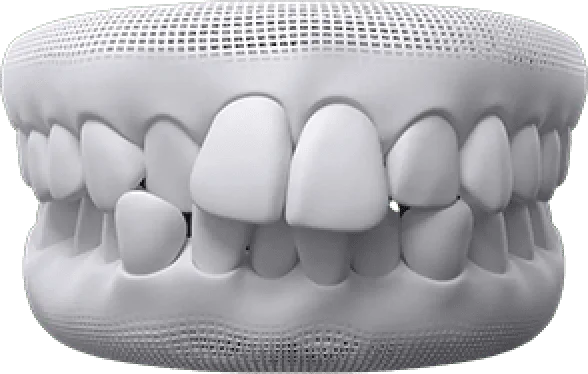 crowded_teeth