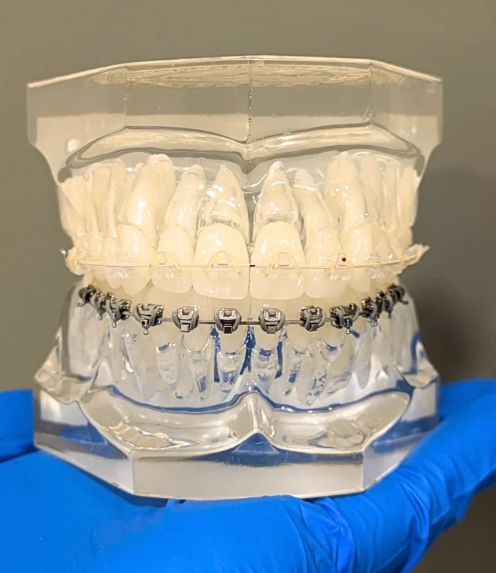 Fixed-Braces