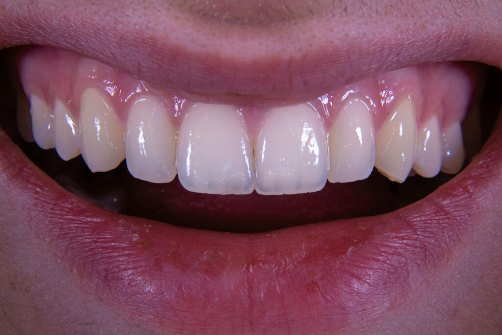 Teeth Whitening