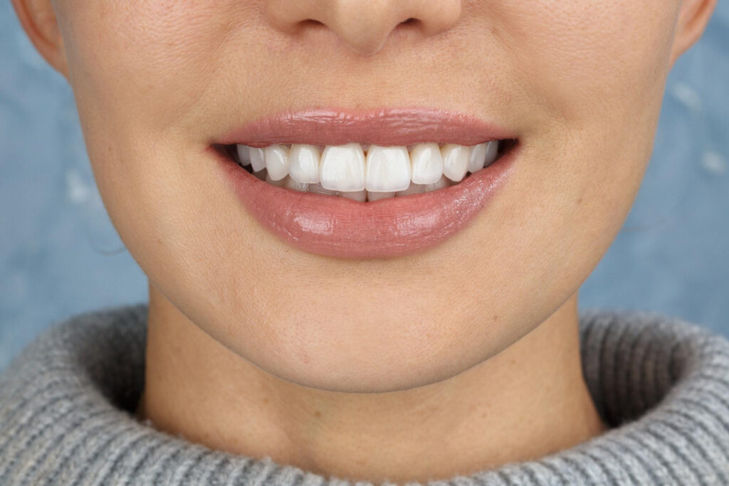 veneers