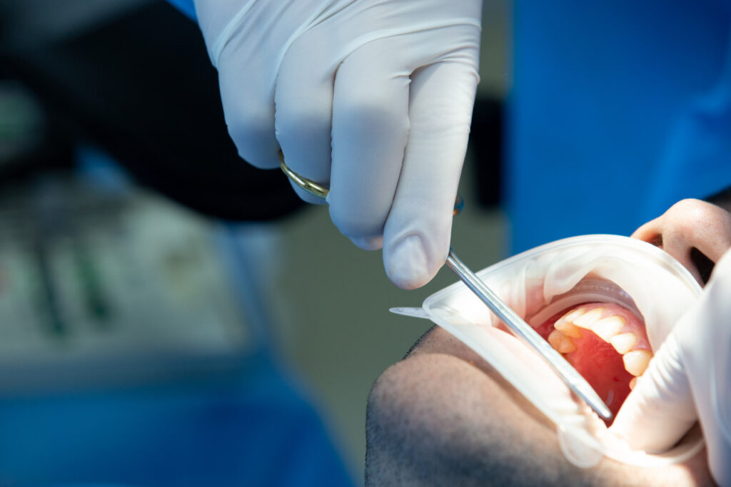 root canal