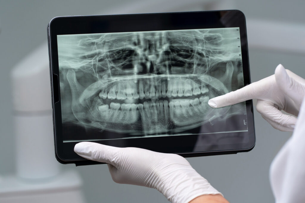 All-on-4 Dental Implants