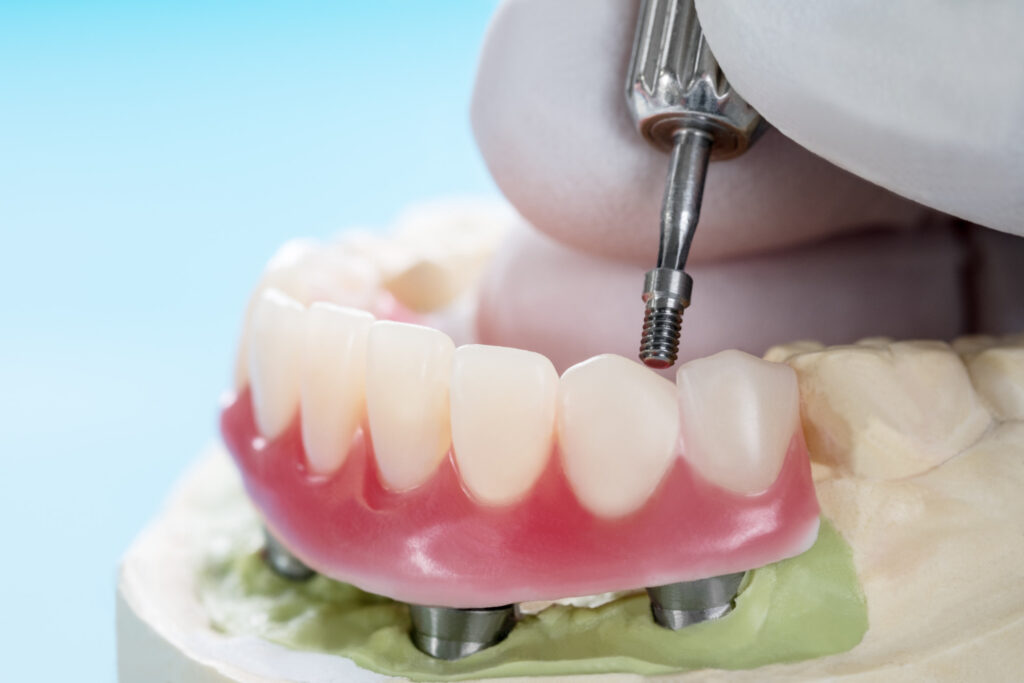Dental Implant